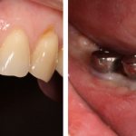 dental implantation