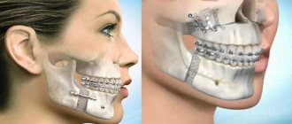 Correcting jaw asymmetry