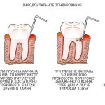 measurement of periodontal pockets