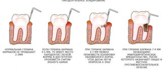 измерение пародонтальных карманов