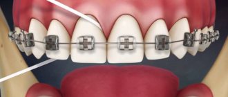 how to use dental floss with braces, clean until shiny