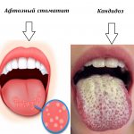 What does candidiasis and aphthous stomatitis look like?