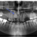 Как выглядит зуб мудрости на панорамном снимке