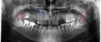 What does a wisdom tooth look like in a panoramic photo?