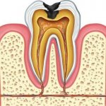 Caries. Dentistry &quot;Smile&quot;. Shchelkovo 