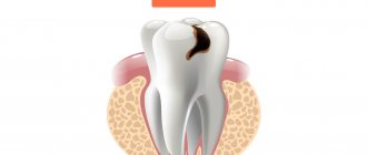 Caries in pictures