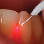 Cyst in the gum - Dentistry Line of Smiles