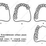 Kennedy classification of dentition