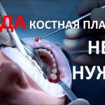 Когда можно обойтись без костной пластики