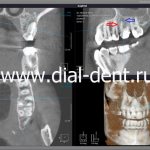 компьютерная томограмма зубов до лечения