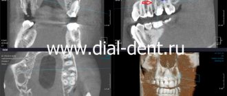 computed tomogram of teeth before treatment