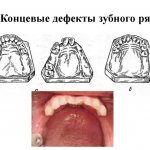 Концевой дефект зубного ряда – особенности протезирования