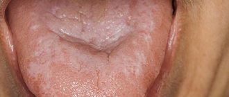 Oral lichen planus