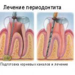 Treatment of periodontitis