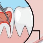 treatment of pulpitis