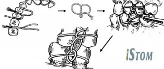 Ivy ligature binding