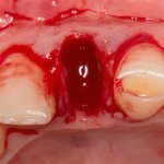 Hole after tooth extraction