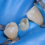 Dental restoration methods