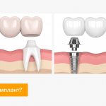 Bridge or implant in pictures