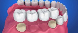 мостовидный зубной протез