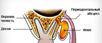 Folk help for tooth root abscess