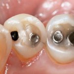 Некариозные поражения твердых тканей зубов: лечить или не лечить?