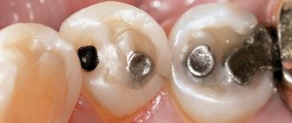 Некариозные поражения твердых тканей зубов: лечить или не лечить?
