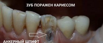 The lower canine under the filling is affected by caries. And you see the anchor pin. We will delete it. Doctor - Sergey Samsakov, CERECON dental clinic 