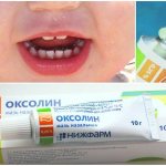 Oxolinic ointment for stomatitis