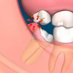 swollen gums near the wisdom tooth