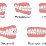 Ортодонтическое лечение - исправление неправильного прикуса