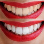 Teeth whitening in Minsk