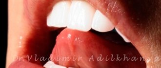 Teeth whitening in dentistry Prosmail.RU