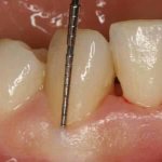 open curettage of periodontal pockets