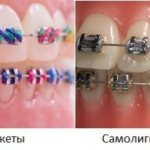 Differences between braces