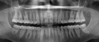 Panoramic photo of teeth
