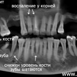 panoramic photo of teeth before treatment