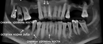 панорамный снимок зубов до лечения