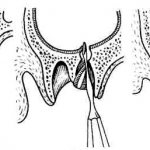 перфорация дна гайморовой пазухи