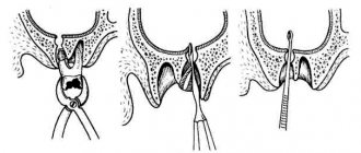 perforation of the maxillary sinus floor