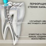 Перфорация зуба при лечении каналов