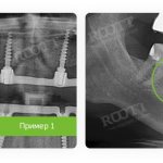 peri-implantitis on x-ray