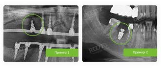 периимплантит на рентгеновском снимке