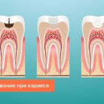 Пломбирование зубов при кариесе без удаления нерва в картинках