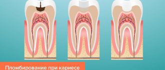 Пломбирование зубов при кариесе без удаления нерва в картинках