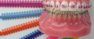 Pros and cons of colored braces