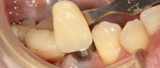 подбор цвета зубных протезов