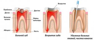 Preparing a tooth for filling