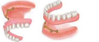 complete removable denture on a bar