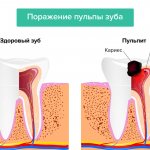 Dental pulp damage in pictures